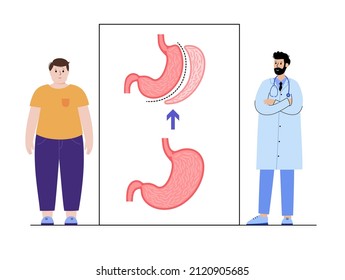 Vertical Sleeve Gastrectomy. Consultation With Doctor In Clinic. Stomach Surgery, Weight Loss Gastric Procedure. Laparoscopy Concept. Overweight Problem In Human Body. Flat Vector Medical Illustration