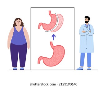 Vertical Sleeve Gastrectomy. Consultation With Doctor In Clinic. Stomach Surgery, Weight Loss Gastric Procedure. Laparoscopy Concept. Overweight Problem In Human Body. Flat Vector Medical Illustration