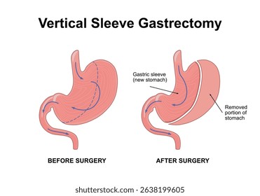 Vertical sleeve gastrectomy. Distended stomach surgery, gastroenterology operation. Weight loss procedure, limiting the size of the stomach. Flat vector illustration