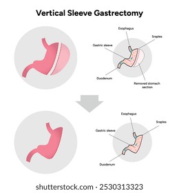 Vertical Sleeve Gastrectomy	gastroenterology medical disease. Medical diagram 