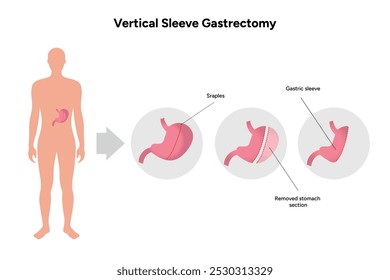 Vertical Sleeve Gastrectomy	gastroenterology medical disease. Medical diagram 