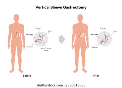 Vertical Sleeve Gastrectomy	gastroenterology medical disease. Medical diagram 