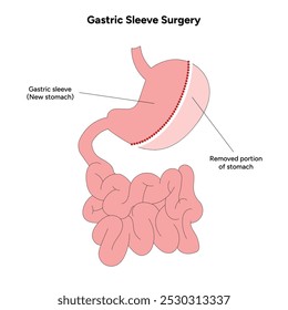 Vertical Sleeve Gastrectomy	gastroenterology medical disease. Medical diagram 