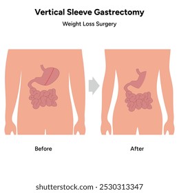 Vertical Sleeve Gastrectomy	gastroenterology medical disease. Medical diagram 