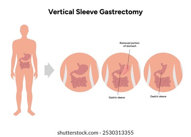 Vertical Sleeve Gastrectomy	gastroenterology medical disease. Medical diagram 