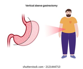 Vertical sleeve gastrectomy. Male silhouette with obesity. Stomach surgery, weight loss gastric procedure. Laparoscopy concept. Overweight problem in human body. Flat vector medical illustration