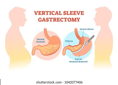 Vertical Sleeve Gastrectomy medical vector illustration diagram with stomach surgical cut. Anatomical diagram. 