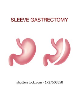 209 Gastric sleeve Images, Stock Photos & Vectors | Shutterstock