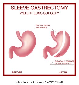 Vertical Sleeve Gastrectomy medical vector illustration diagram with stomach surgical cut.  Bariatric surgery with a reduction of the size of the stomach for weight loss and loss of body weight.