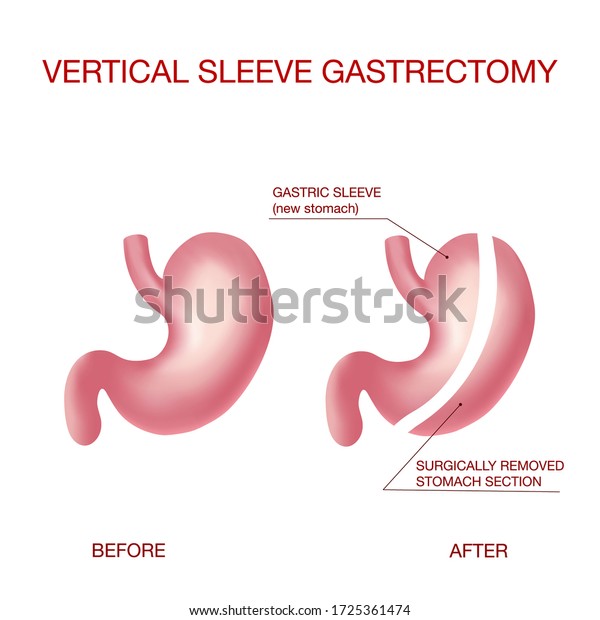 Vertical Sleeve Gastrectomy Medical Vector Illustration Stock Vector Royalty Free 1725361474 4544