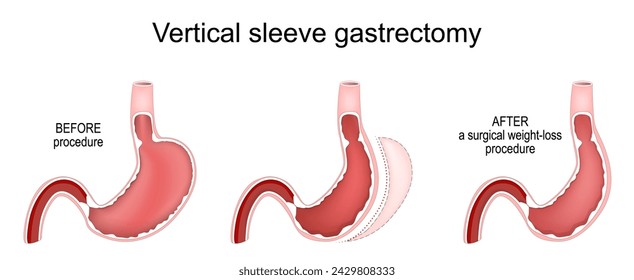 Gastrectomía de manga vertical. Estómago antes y después de un procedimiento quirúrgico de pérdida de peso. Cirugía bariátrica. Tratamiento de la obesidad. Sección transversal de un estómago humano. Ilustración de vector