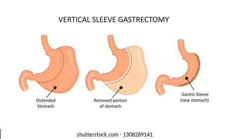 Vertical sleeve gastrectomy. Stomach reduction surgery  
