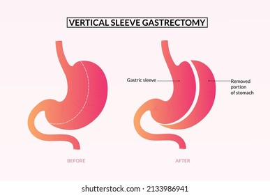 358 Esophageal surgery Images, Stock Photos & Vectors | Shutterstock