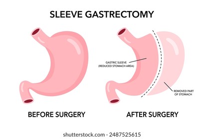 Vertical sleeve gastrectomy surgery medical vector illustration.