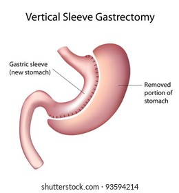 Vertical Sleeve Gastrectomy (VSG)  Weight Loss Surgery