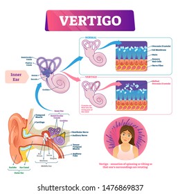 Vertigo vector illustration. Labeled medical vestibular ear problem scheme. Anatomical inner earlobe and canal detailed structure. Disease explanation with otoconia crystals disease comparison diagram