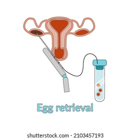 Vertor illustration for specialized manuals. Oocyte retrieval. Egg donation. Donor. Extracorporeal fertilization. Flat style vector. 