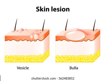 Vesicle And Bulla. Skin Lesion. Bulla Is A Large Vesicle Containing Fluid