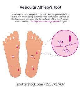 Vesicular Athlete's Foot educational vector infographic