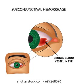 Das Gefäß im Auge platzte. Entzündung und Rötung. Die Struktur des Auges. Infografiken. Vektorillustration auf isoliertem Hintergrund.