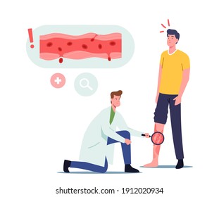 Vessels Inflammation, Rosacea Vasculitis Concept. Doctor Character with Magnifying Glass Looking on Patient Foot with Diseased Inflammated Veins. Health Care, Podiatry. Cartoon Vector Illustration