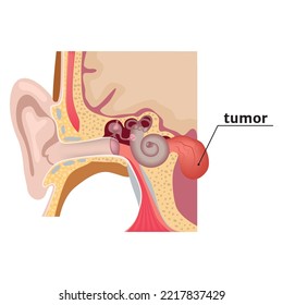 Vestibular Schwannoma. Diagram With A Tumor In The Inner Ear. Vector Illustration