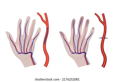 Vibration Syndrome. Hand With A Diagram Of Constricted Blood Vessels. Medical Poster. Vector Illustration