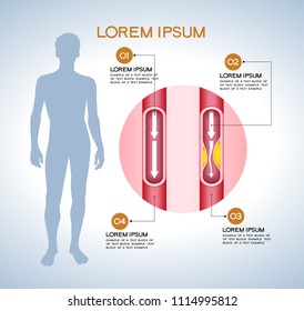 vienna human atherosclerosis.the structure of a veins . the veins in the manifestation of the disease. Modern medical infographics. Internal organs in a human body. Anatomy of people
