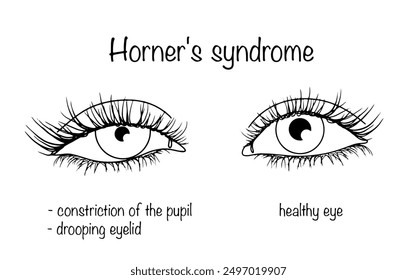 Violation of the innervation of the oculomotor and intraocular muscles. Sagging of the upper eyelid and a decrease in the diameter of the pupillary opening. Hand drawn ophthalmic disease. Vector.