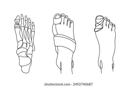 Violación de la integridad del hueso del dedo gordo. Dedo del pie roto. Tratar la fractura con un yeso u ortesis. Ilustración vectorial sobre un tema médico.