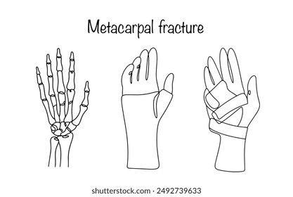 Violation of the integrity of the normal bone structures located between the wrist and phalanges of the fingers. Drawn bones of the hand and an arm in an orthosis. Vector illustration.