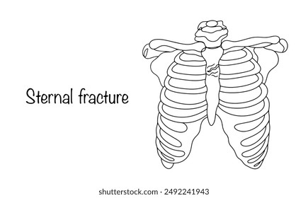 Violation of the integrity of the sternum bone as a result of mechanical or kinetic effects. Sternal fracture. Vector illustration.