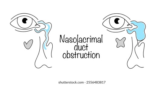 Violation of the unimpeded flow of tear fluid into the nasal passage. Drawn healthy nasolacrimal duct and nasolacrimal duct obstruction. Medical vector isolated on white background.