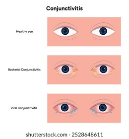 Conjuntivite viral e bacteriana. Doenças oftalmológicas