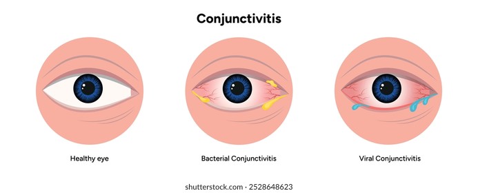 Viral and bacterial conjunctivitis. Ophthalmology diseases