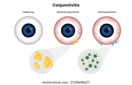 Viral and bacterial conjunctivitis. Ophthalmology diseases