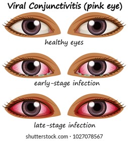 Viral conjuctivitis in human eyes illustration