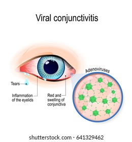 Viral conjunctivitis. Adenoviruses is the cause of viral conjunctivitis