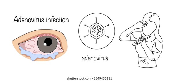 A viral disease caused by an adenovirus, which manifests itself with symptoms of acute respiratory viral infection and intestinal upset. A drawn adenovirus and the main symptoms of its manifestation.