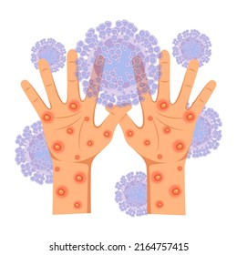 Viral Infectious Disease Monkeypox Virus. Human Hands Affected By A Rash, Covered With Purulent Ulcers And Pimples. Vector Illustration.