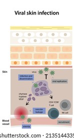 Viral Skin Infection. Sheme Of Viral Replication Going Through Processes Of Infection And Dissemination, Vascular Leakage And Viremia.