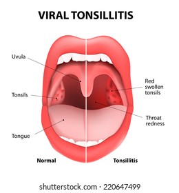 viral tonsillitis or upper respiratory tract infection. URI or URTI. 