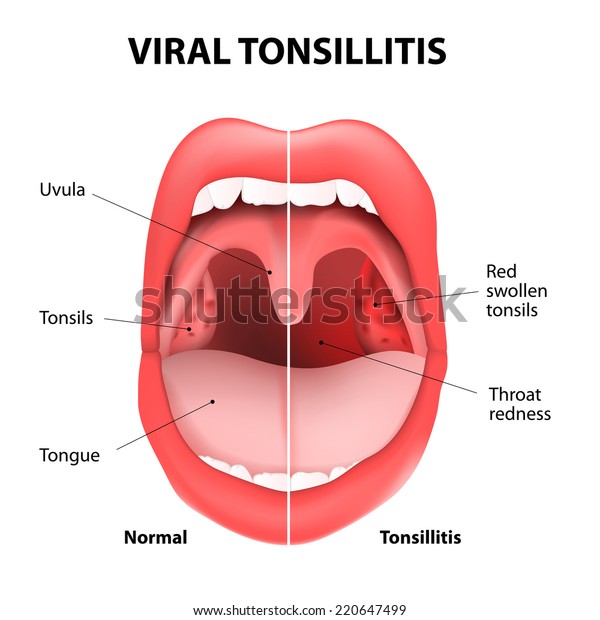 viral-tonsillitis-upper-respiratory-tract-infection-lagervektor