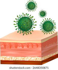 Virus Atacando Las Capas De La Piel Humana. Ilustración de anatomía médica. Sección transversal de la piel infectada por virus. Infección cutánea con virus