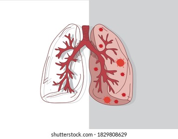 Virus cells in lung. Infected lungs. Coronavirus, COVID-19. 2019-nCoV. lung disease, pneumonia.

