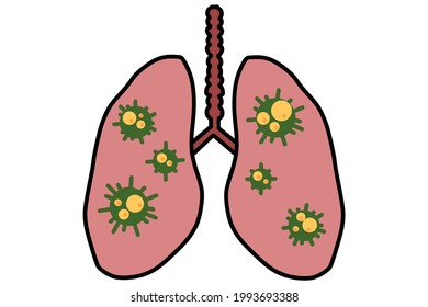 Virus cells in lung. Infected lungs. Coronavirus, COVID-19. 2019-nCoV. lung disease, pneumonia, asthma, cancer, tuberculosis.