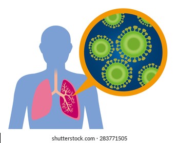 345 Acute Respiratory Tract Infection Images, Stock Photos & Vectors ...