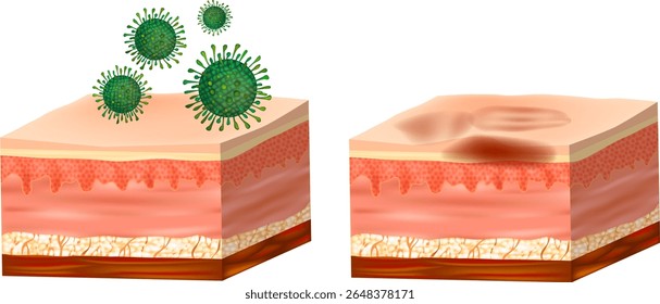 Virus Infection and Damaged Skin Layers. Skin Structure Before and After Viral Infection. Virus Impact on Human Skin. Cross Sectional Dermatology Diagram