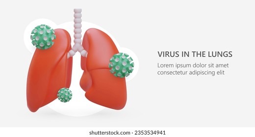 Virus in lungs. Realistic color illustration. Corona virus attack. Inflammatory disease of respiratory tract, SARS. Advertisement of clinic and doctor services. Propaganda of vaccination