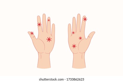 Virus on humans hands. Vector flat style illustration isolated on white background